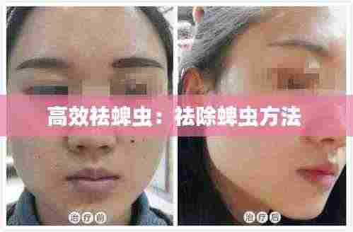 高效祛蜱虫：祛除蜱虫方法 